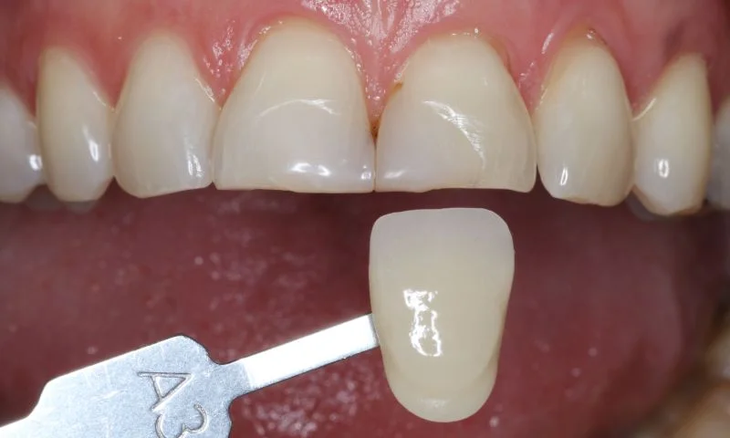 Die Farbe der natürlichen Zähne entspricht dem Farbton A3 der VITA classical A1-D4® Farbskala.