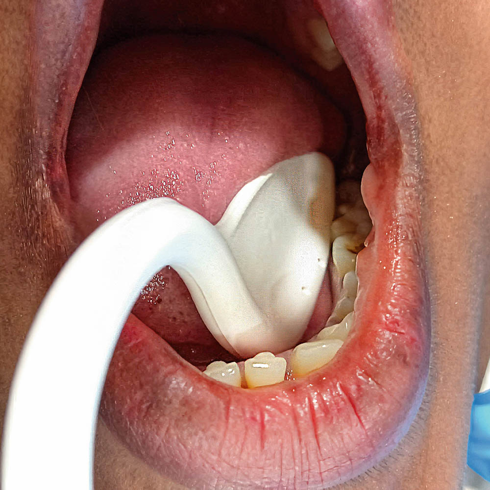 SWE-Flex Speichelsauger mit Zugenhalter, 100 Stück