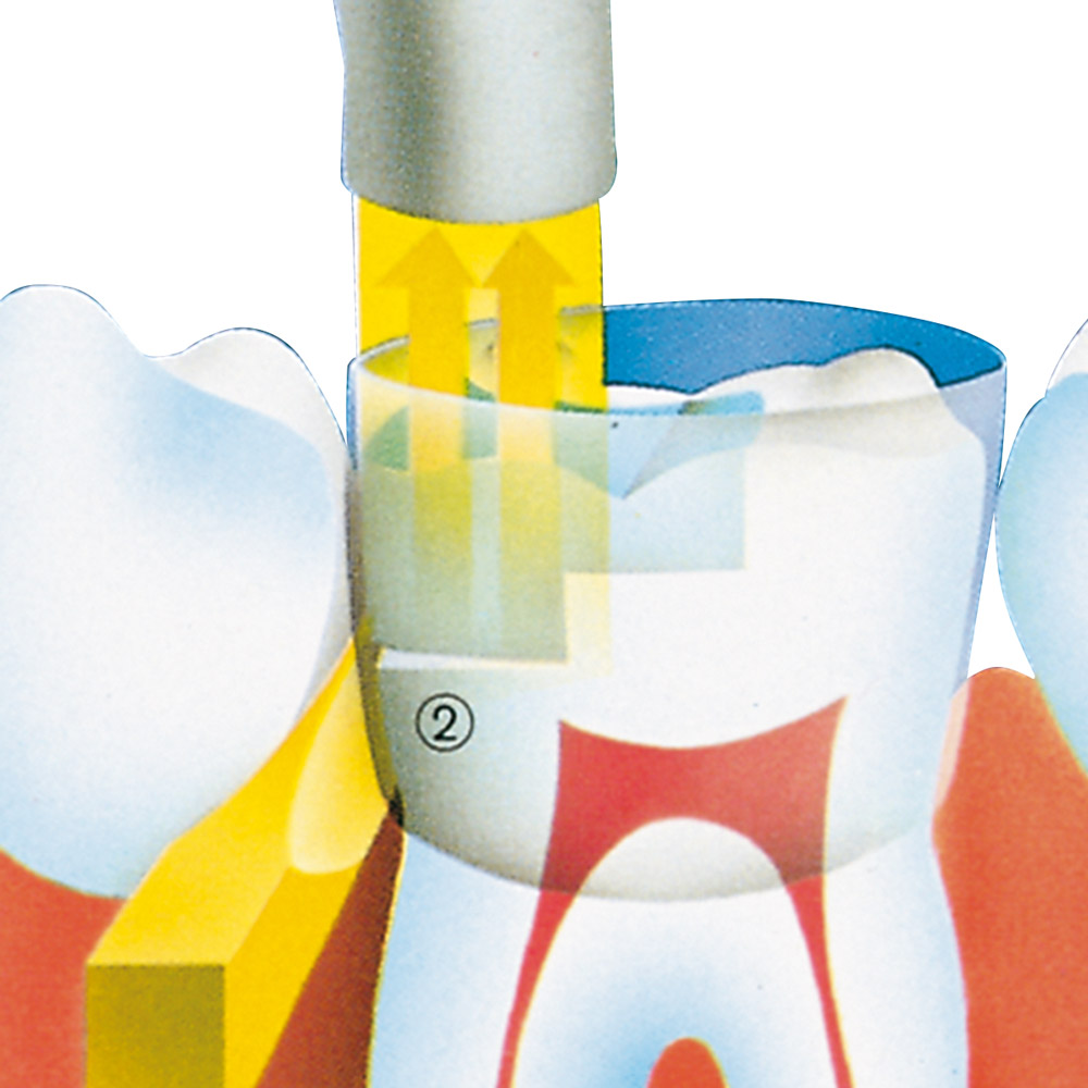 Molarbänder transparent, Packung