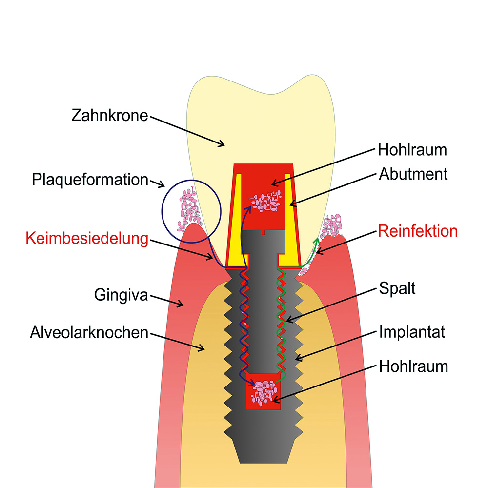 GapSeal (Applikator+Tips), Set