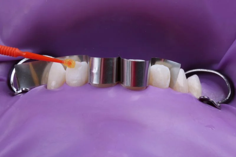 Anwendung von 3M™ Scotchbond™ Universal Plus Adhäsiv.