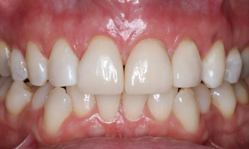 Postoperative Aufnahme der Zähne in Okklusion.