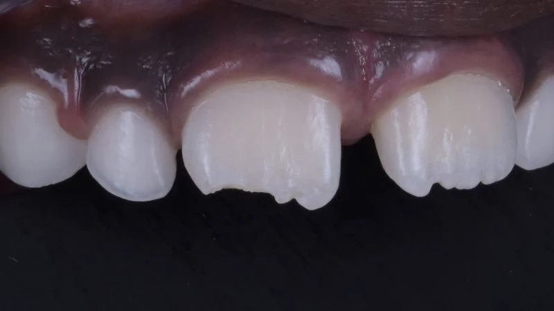 Detailansicht des frakturierten Zahnes.