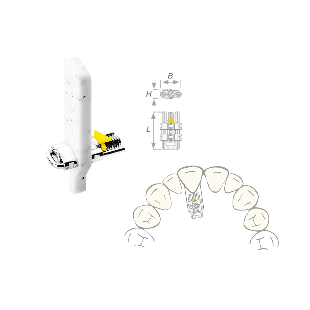Dehnschraube Vector 350 micro, 10 Stück