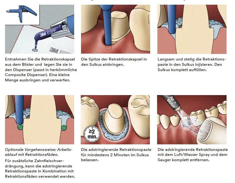 3M™ Adstringierende Retraktionspaste: Schritt-für-Schritt Anweisungen für bestmögliche Ergebnisse.