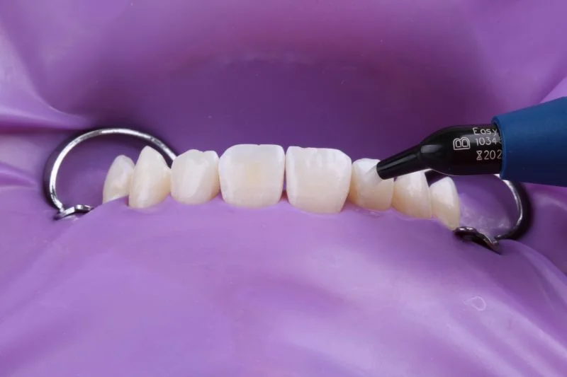 Applikation von 3M™ Filtek™ Easy Match, Farbton Bright.