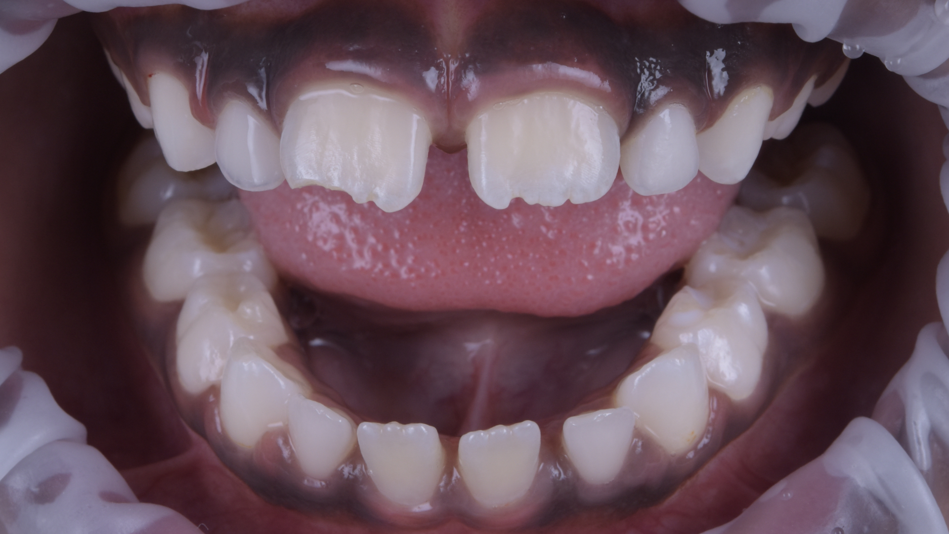 Restauration einer frakturierten Inzisalkante bei einer jungen Patientin