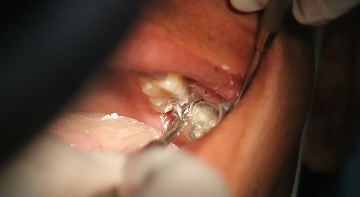 Amalgam-Verbot 2025: Was verändert sich für Zahnärzte?