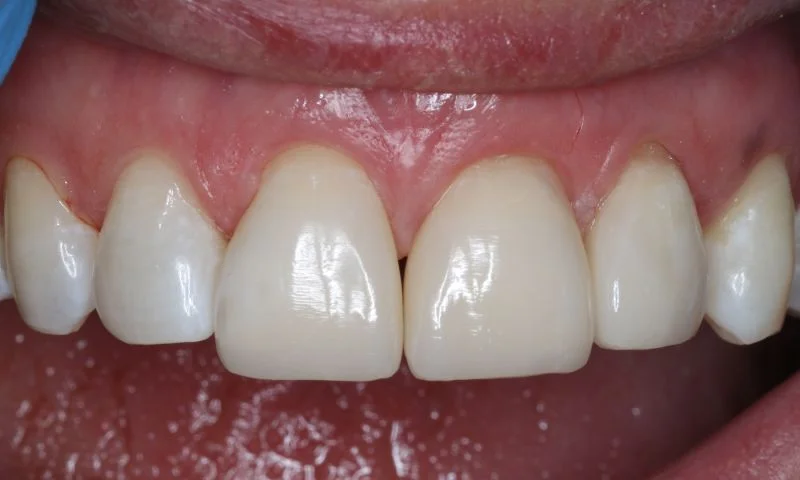 Ergebnis unmittelbar nach Behandlungsabschluss.