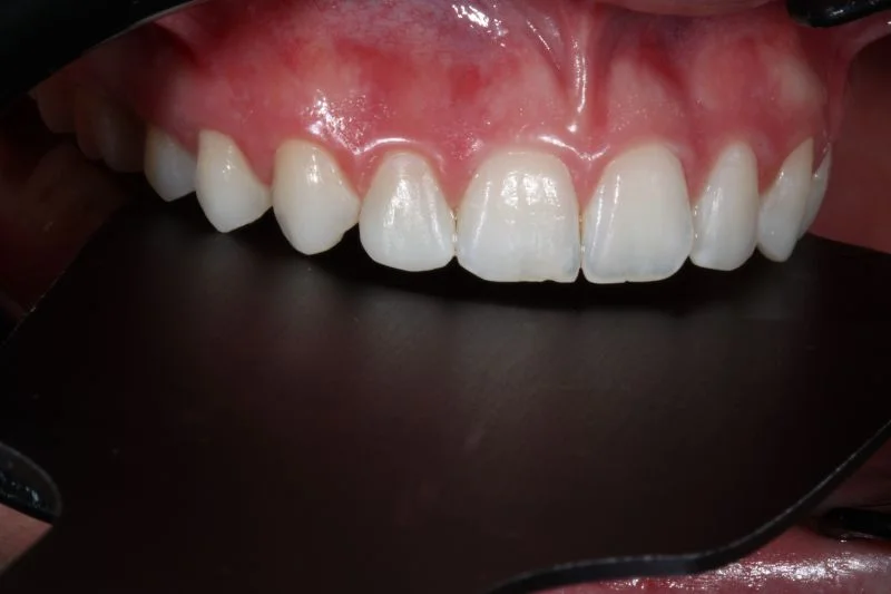 Definitive Restaurationen: Ansicht von lateral.