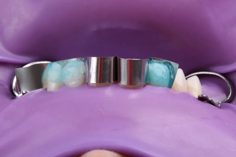 Ätzen mit Phosphorsäure-Gel.