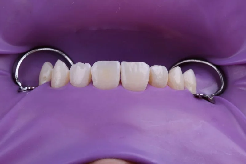 Isolierung mit Kofferdam.