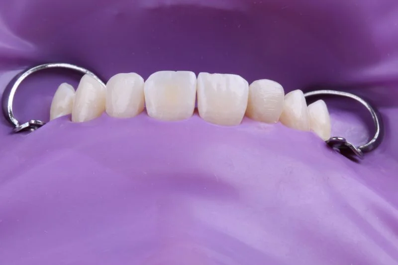 Ausgearbeitete Restaurationen vor der Politur.