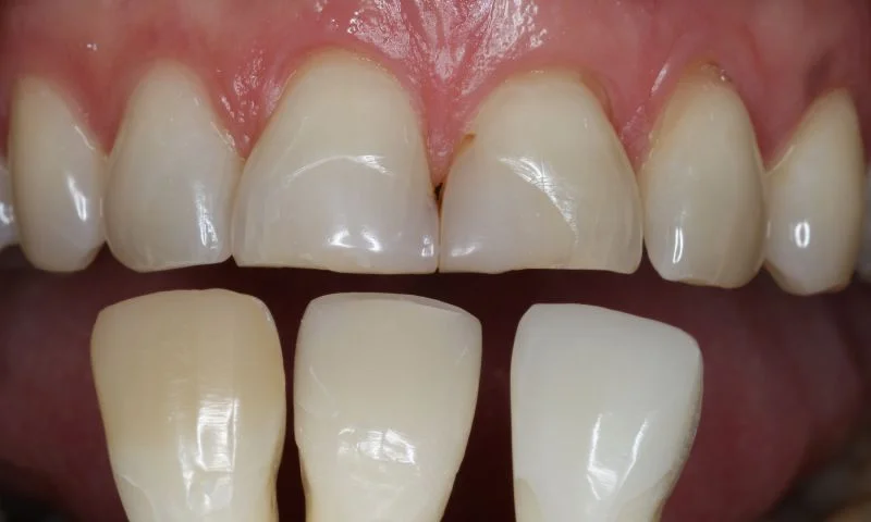 Farbauswahl mit 3M™ Filtek™ Easy Match Universal Komposit