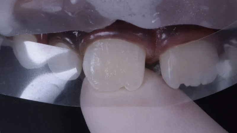 Ein Finger dient als Grundlage für die Applikation von 3M Filtek Easy Match Universal Komposit im Farbton Bright zur Wiederherstellung der Form, Kontur und Ästhetik.