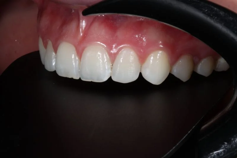 Definitive Restaurationen: Ansicht von lateral.