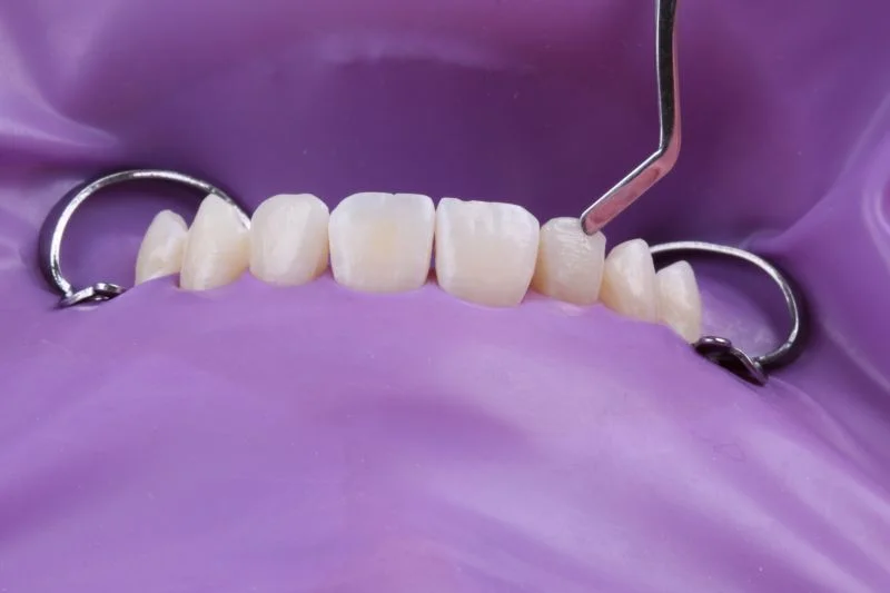 Anatomische Modellation des Zahns 12 mit einem Spatel.