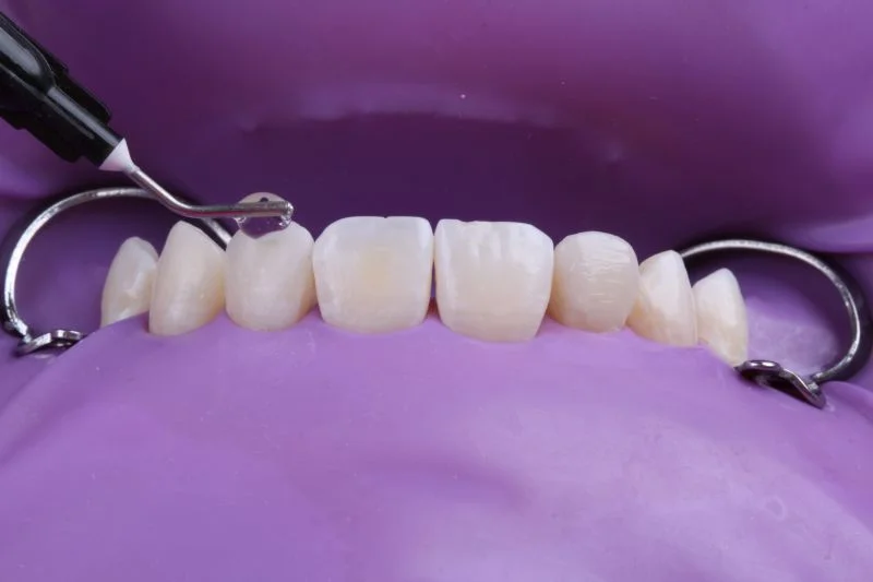 Applikation von Glyceringel vor Lichthärtung