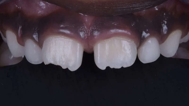 Detailansicht der Oberkiefer-Frontzähne.