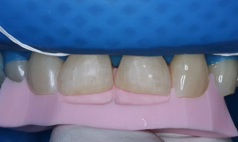 Einprobe des Silikonschlüssels zur Passungskontrolle.