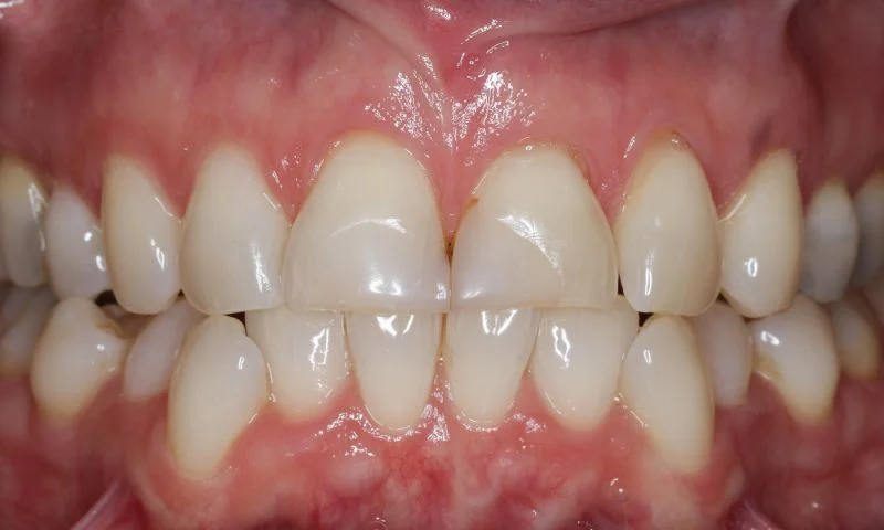 Ausgangssituation: Zähne in Okklusion.