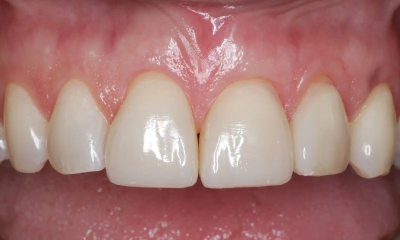 Ergebnis nach vier Wochen.