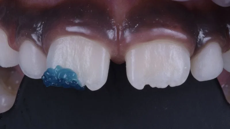 Konditionierung des Schmelzes an Zahn 11 mit 3M Scotchbond Universal Ätzgel.