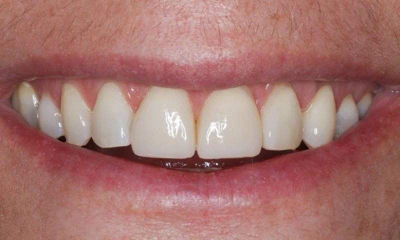 Lächeln der Patientin nach vier Wochen.