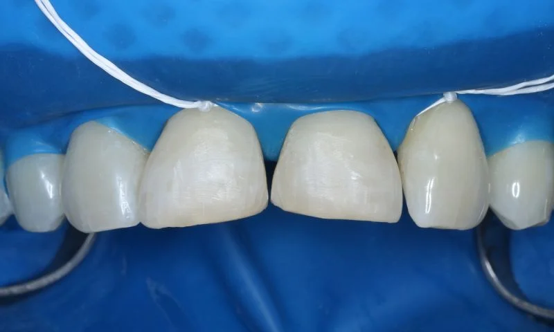 Absolute Trockenlegung mit Kofferdam.