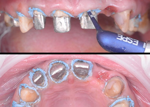 Retraktion in Aktion: Den Weg zum Erfolg ebnen