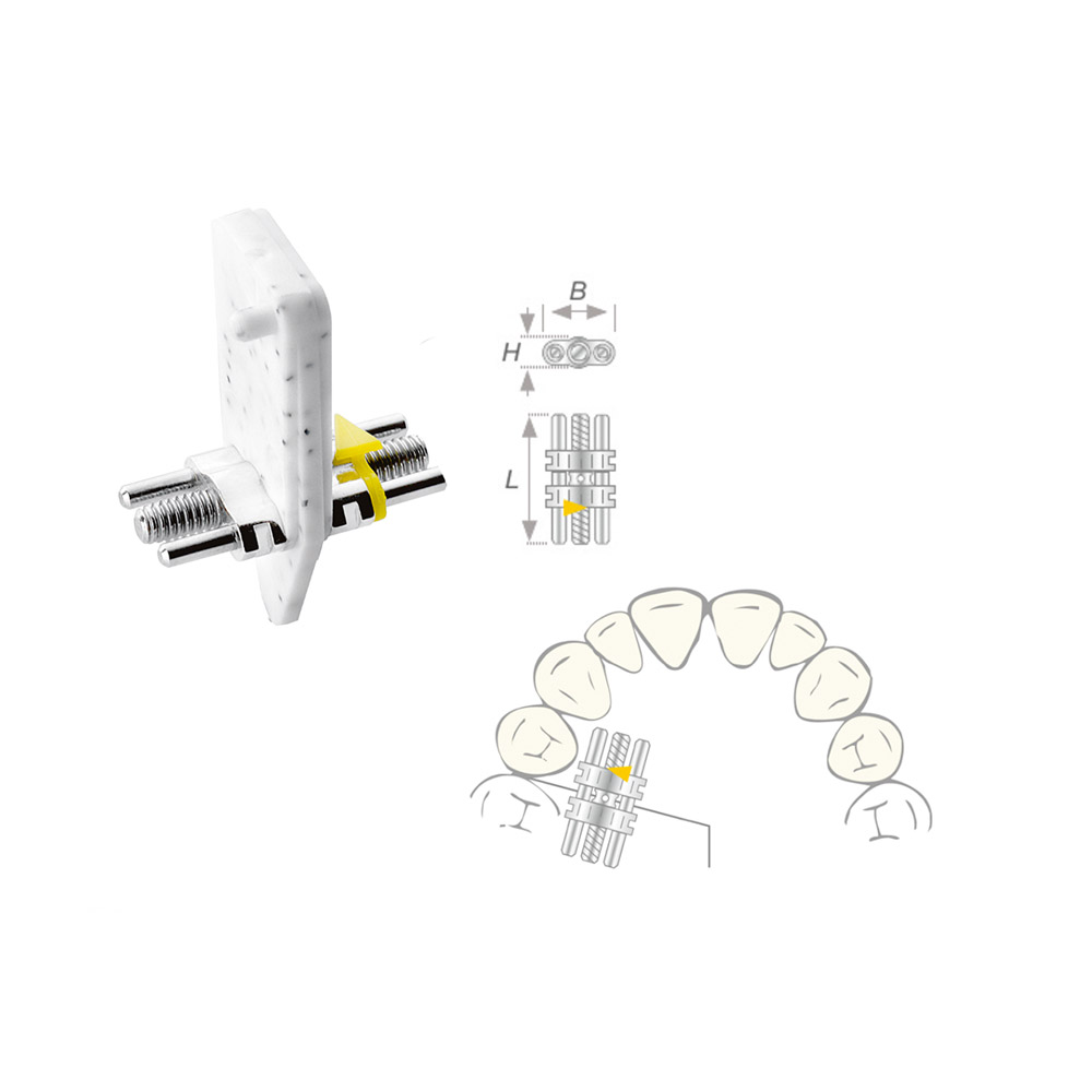 Dehnschraube Vector 160 medium, 10 Stück