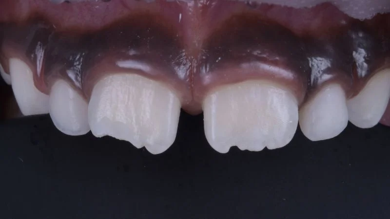 Schmelzklebefläche an Zahn 11 nach dem Ätzen.