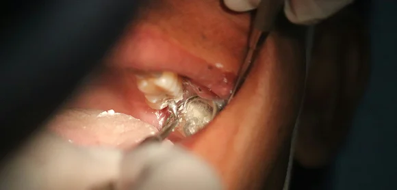 Amalgam-Verbot 2025: Was verändert sich für Zahnärzte?