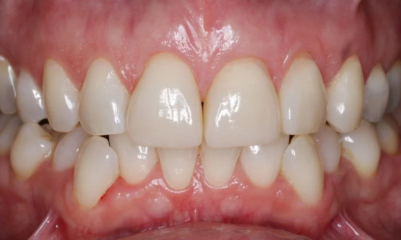 Zähne in Okklusion nach vier Wochen.