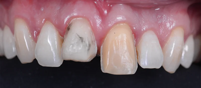 Durch Eisensulfat verursachte dunkle Verfärbungen auf der Zahnoberfläche nach Entfernung des Provisoriums.