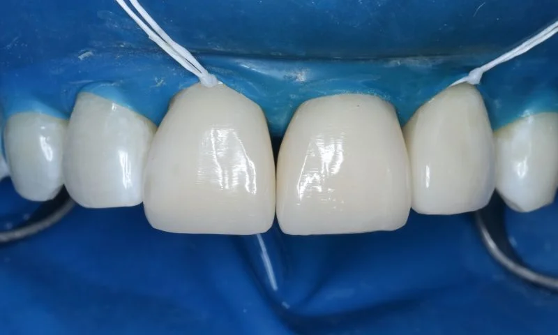 Restaurationen an den Zähnen 11 und 21 vor der Ausarbeitung und Politur.