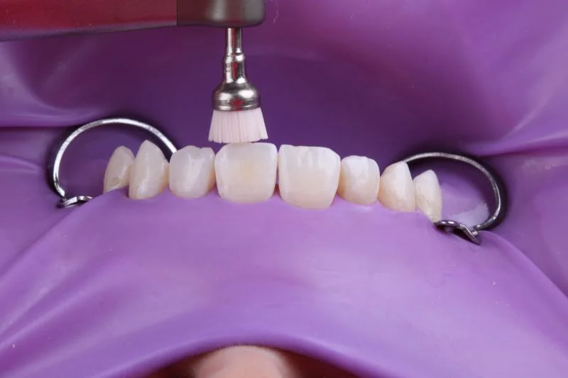 Entfernung des Biofilms mit Bimssteinpaste und einer Prophylaxebürste.