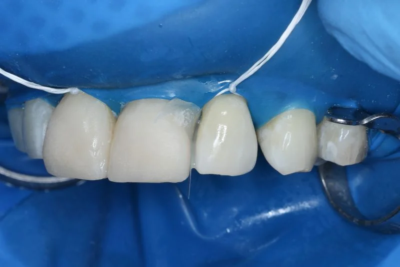 Restaurationen an den Zähnen 11 und 21 nach Ätzen der Präparation mit Phosphorsäure-Ätzgel und Applikation von 3M™ Scotchbond™ Universal Plus Adhäsiv sowie Aufbau mit Komposit.