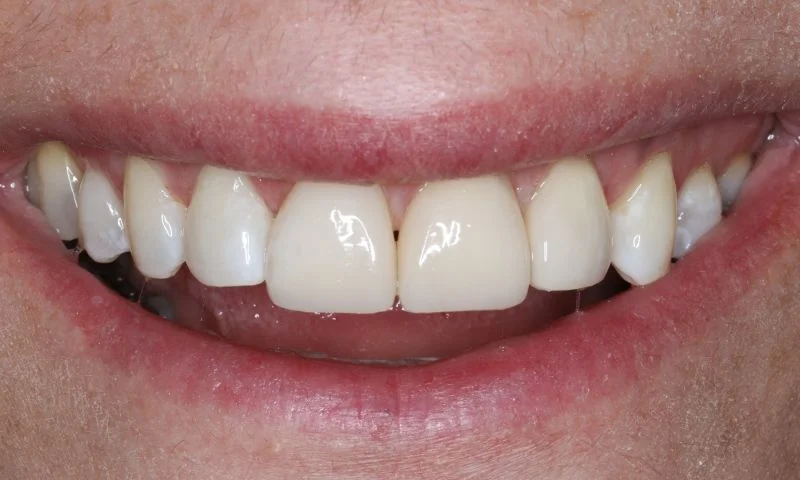 Lächeln der Patientin unmittelbar nach der Behandlung.