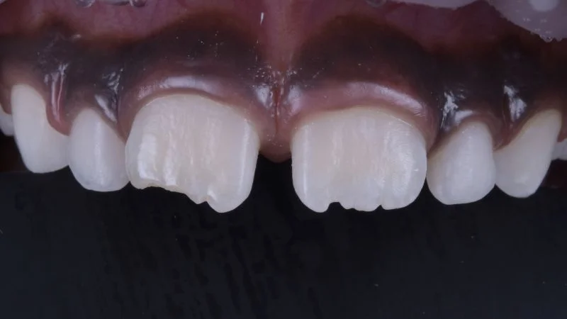 Klebefläche an Zahn 11 nach der Applikation von 3M Scotchbond Universal Plus Adhäsiv.