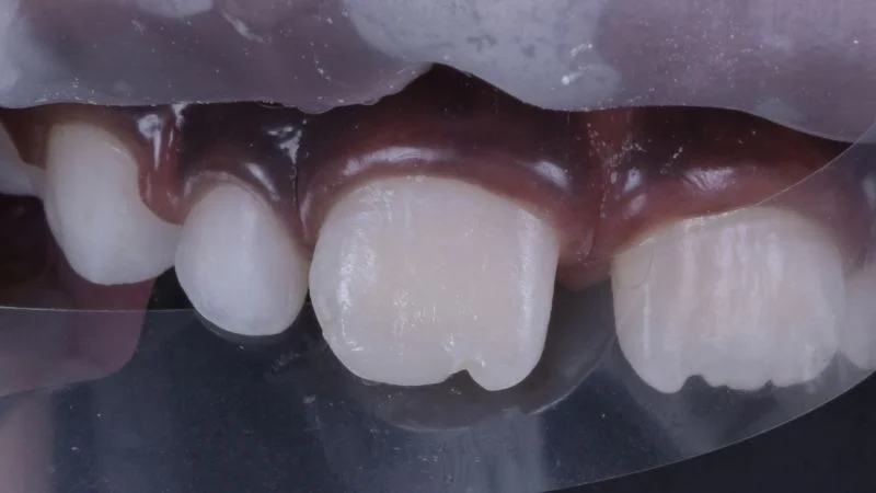 Freihand-Modellation der Komposit-Restauration.