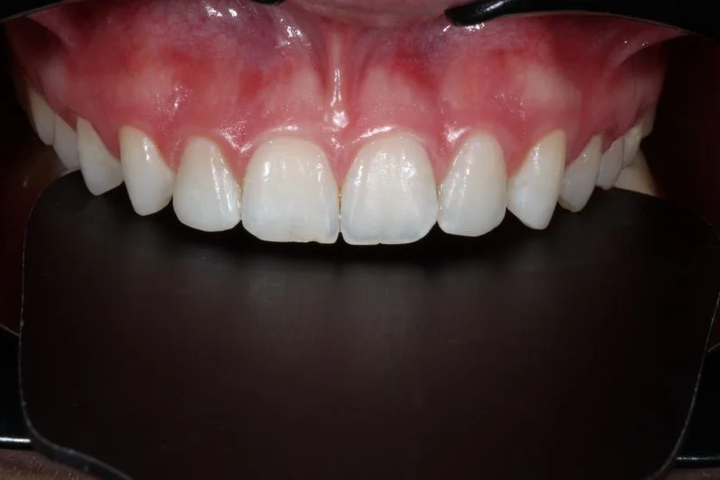 Behandlungsergebnis nach Ausarbeitung und Politur mit 3M™ Sof-Lex™ Scheiben und Rädern.