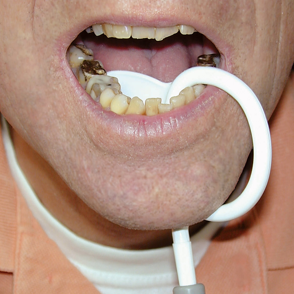 SWE-Flex Speichelsauger mit Zugenhalter, 100 Stück