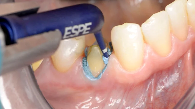 3M™ Adstringierende Retraktionspaste mit AlCl3, eingesetzt zur Retraktion.