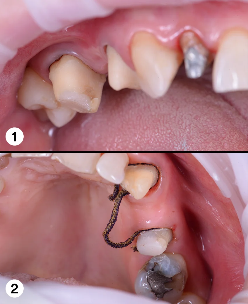 Klinische Situation nach Retraktion der Gingiva.