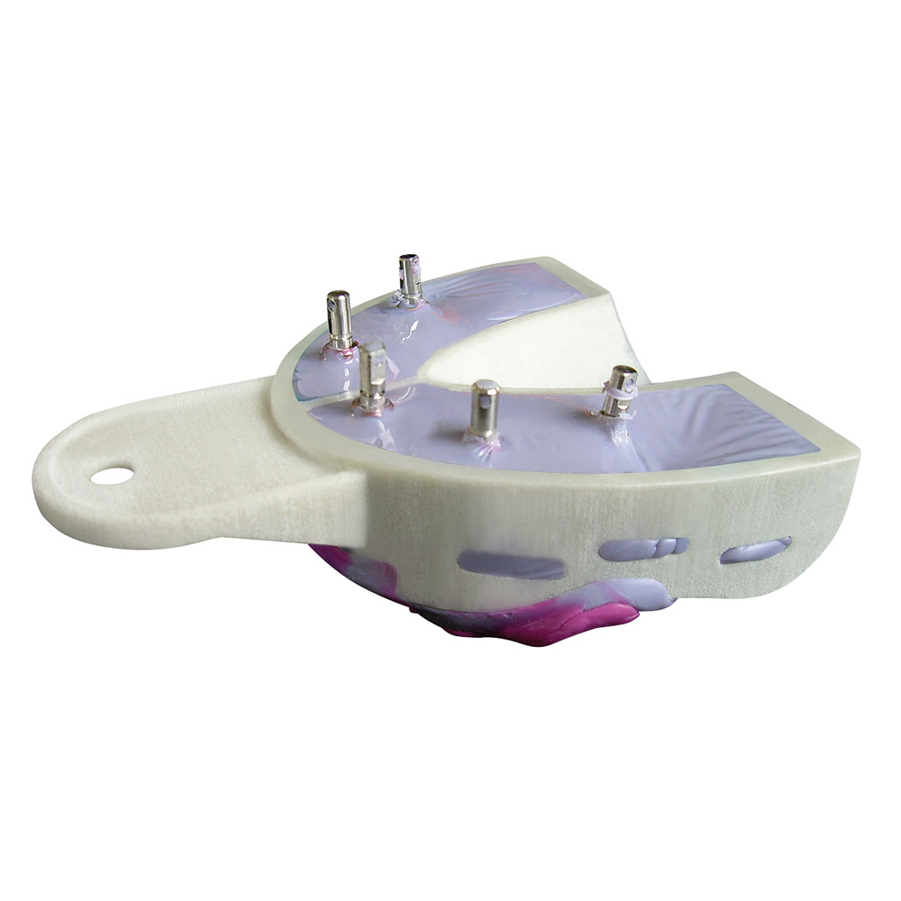 Miratray Implant afdruklepel UK I2, 6 stuks Set