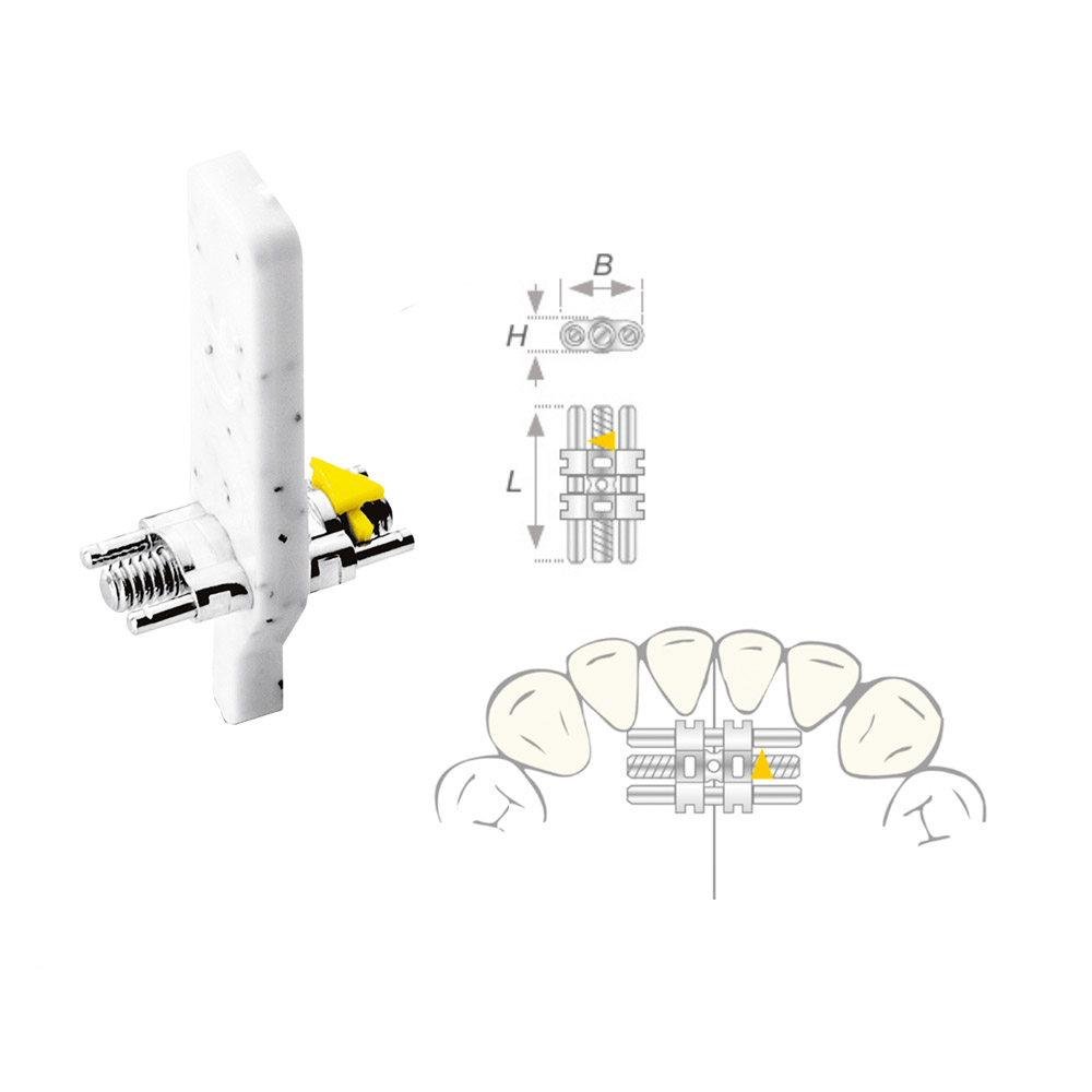Vector uitreksschroef 050 micro, 10 stuks